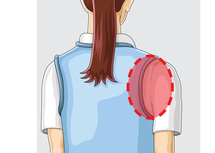 Rückenschutz Schulterbereich